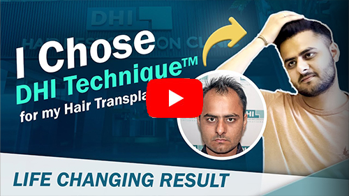 Hair Transplant Testimonial